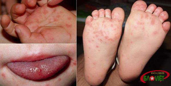 Dấu hiệu cảnh báo bệnh tay chân miệng giai đoạn nặng ở trẻ em