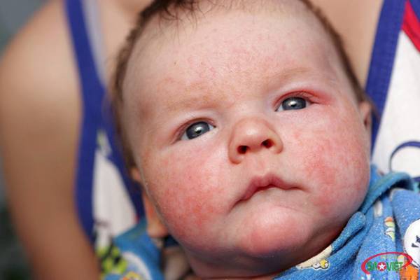 6 bệnh ngoài da ở trẻ em - cách nhận biết và điều trị hiệu quả